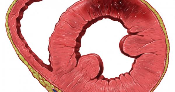 How to Reverse Heart Disease with the Coronary Calcium Score