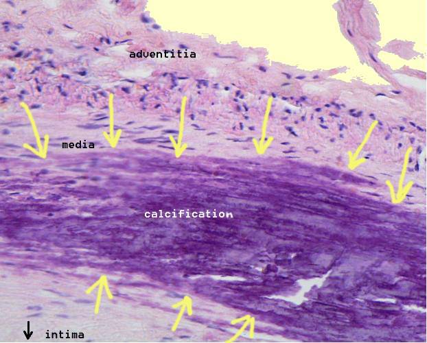 How to Reverse Heart Disease with the Coronary Calcium Score