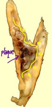 How to Reverse Heart Disease with the Coronary Calcium Score