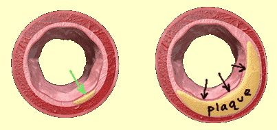 How to Reverse Heart Disease with the Coronary Calcium Score