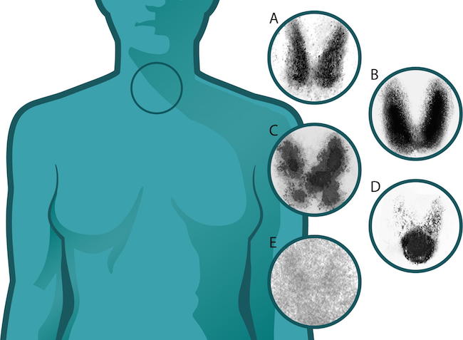 Thyroid Cancer Epidemic of Overdiagnosis