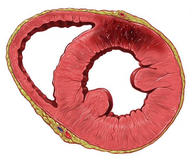 How to Reverse Heart Disease with the Coronary Calcium Score