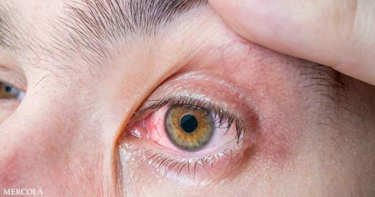 One in Three People Has This Eye Parasite