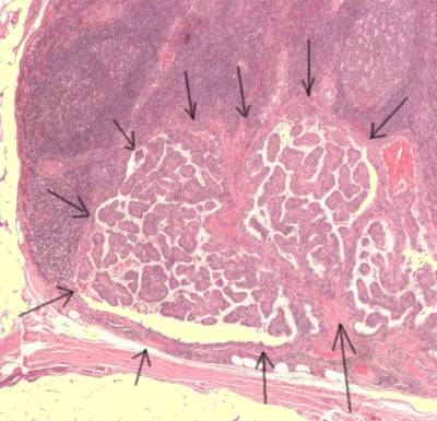 Description: apillary thyroid cancer in lymph node