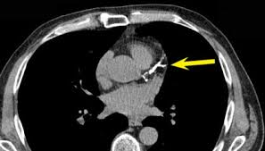 Coronary Artery Calcification