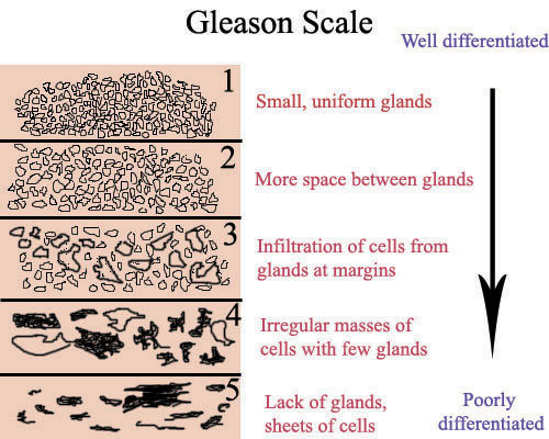 Gleason Score