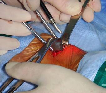 Description: ideo assisted thyroidectomy