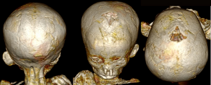 Egyptian child mummies reveal high prevalence of an ancient sickness