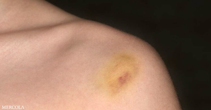 Should This Kind of Bruise Concern You?
