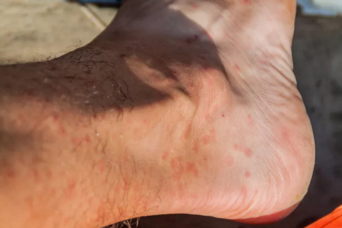 Mosquito bites versus sand fly bites: what to know about Leishmaniasis risk