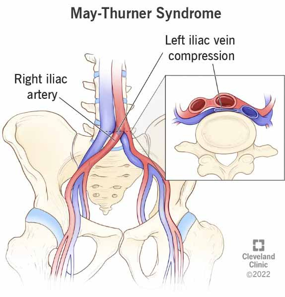 may thunder syndrome