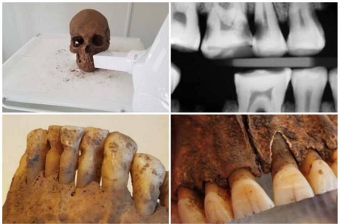 Viking age dental care was surprisingly good, says study