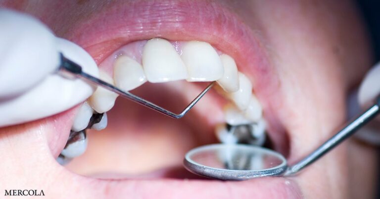 European Ban on Silver Fillings ‘Could Be the Straw That Breaks the NHS Dentistry Back’