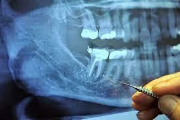 Root canals cause breast cancer - frequently