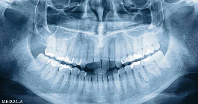 Who Knew Humans Have a Third Set of Teeth?