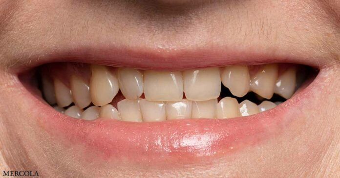 What Happens When You Don't Brush Your Teeth?