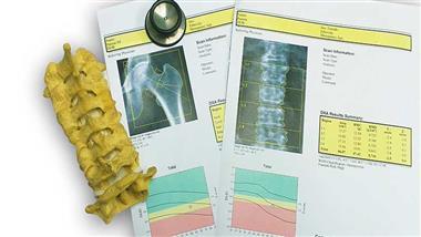 osteoporosis scam