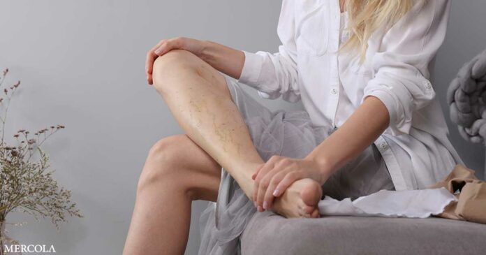 How to ID and Prevent Blood Clots