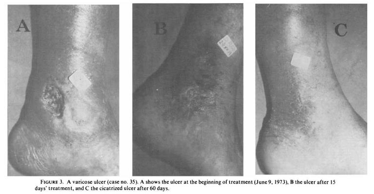 dmso varicose ulcer