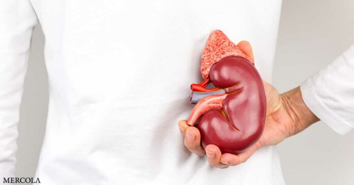 Staghorn Kidney Stones — What They Are and How to Avoid Them