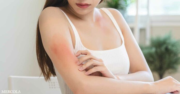 The Link Between Vitamin D and Psoriasis