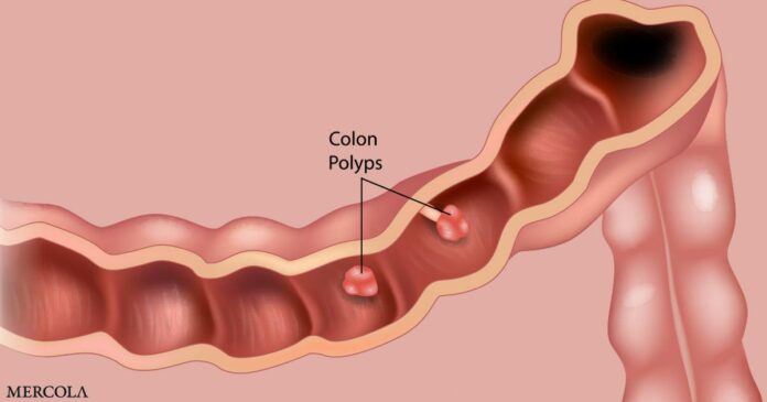 Symptoms of Colon Polyps to Look Out For