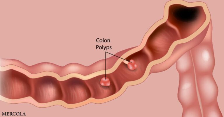Symptoms of Colon Polyps to Look Out For