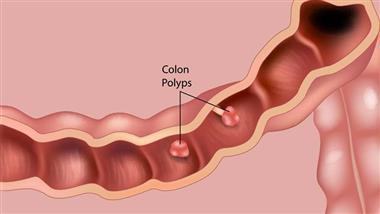 Symptoms of Colon Polyps to Look Out For