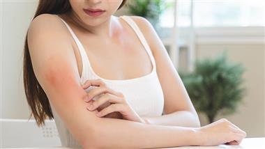 link between vitamin d and psoriasis