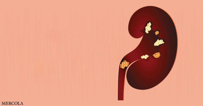 High-Fat Diet Linked to Increased Risk of Kidney Stones