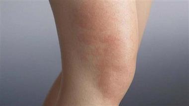 toasted skin syndrome