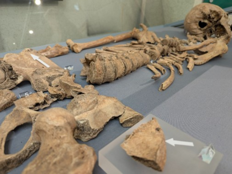 Skeletal evidence of Roman gladiator bitten by lion in combat