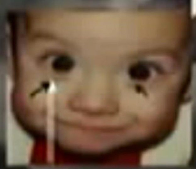 both eyes moving inward