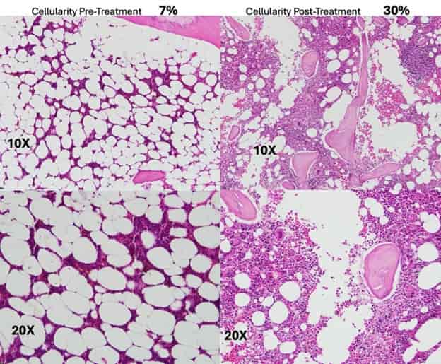 bone marrow changes
