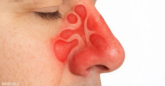 Natural Sinusitis Treatments That Actually Work