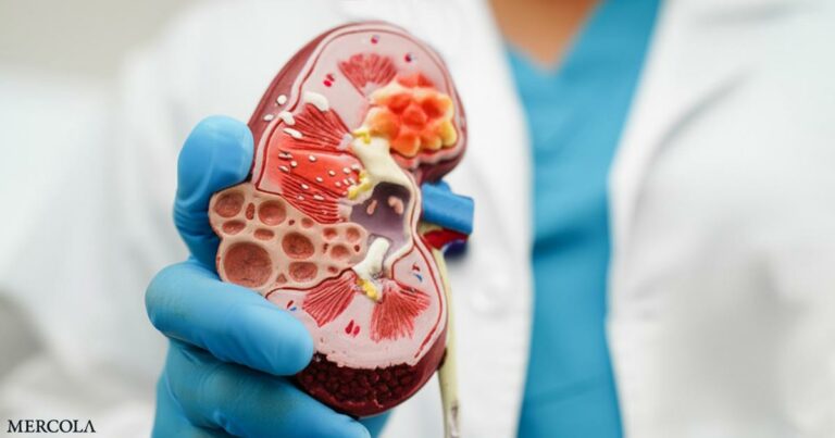 Could Low Testosterone Be Secretly Driving Your Kidney Stone Risk?