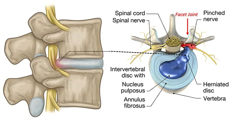 disc herniations