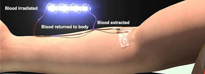 blood irradiation