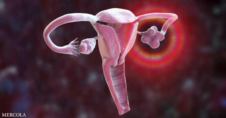 What to Do if You Get Diagnosed with an Ovarian Cyst