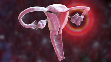 what to do diagnosed with an ovarian cyst